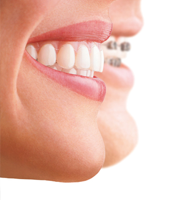 Invisalign en Baza