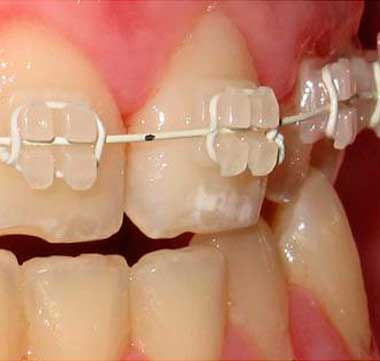 Ortodoncia Estética Baza