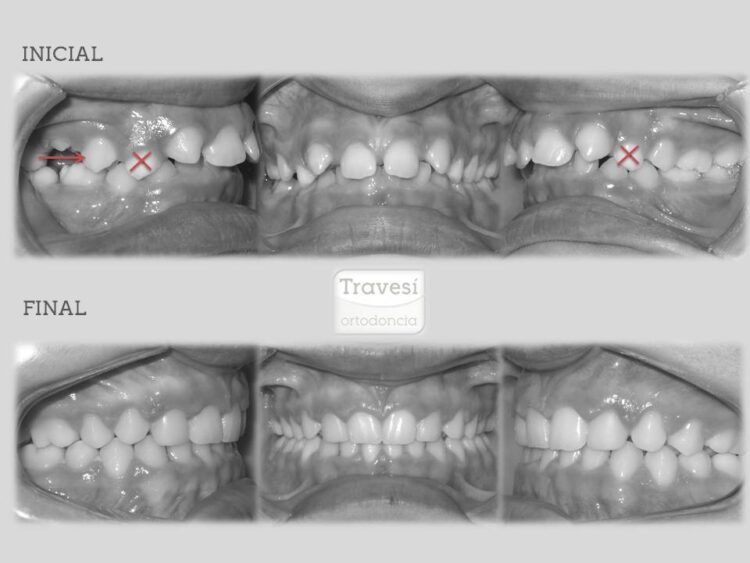 Agenesia de Incisivos laterales superiores con mesialización de arcada completa y transformación de caninos superiores