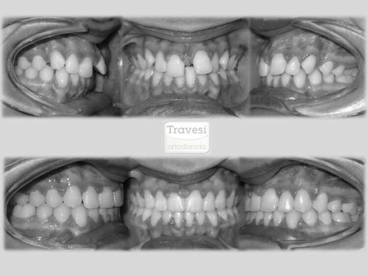 CASO 3 Caso Diastema Severo