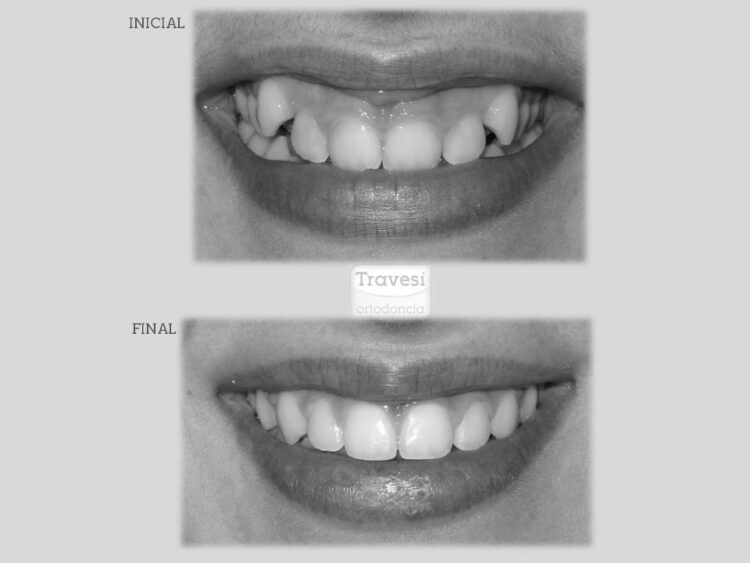 CASO 4 Sonrisas caso caninos altos