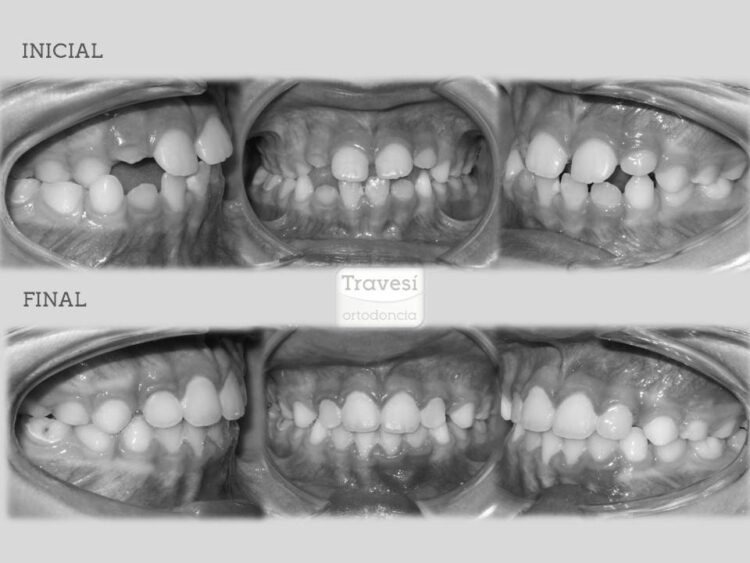 CASO 5 Mordida cruzada Unilateral