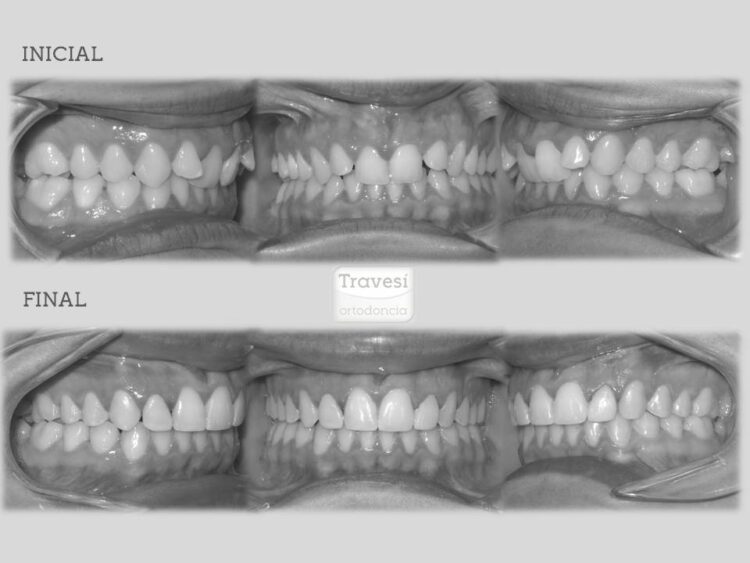 Clase II división segunda con falta de torque anterior