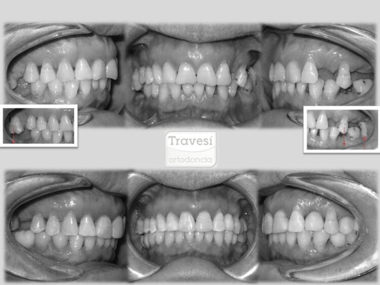 Intrusión de molares para colocación de implantes con invisalign