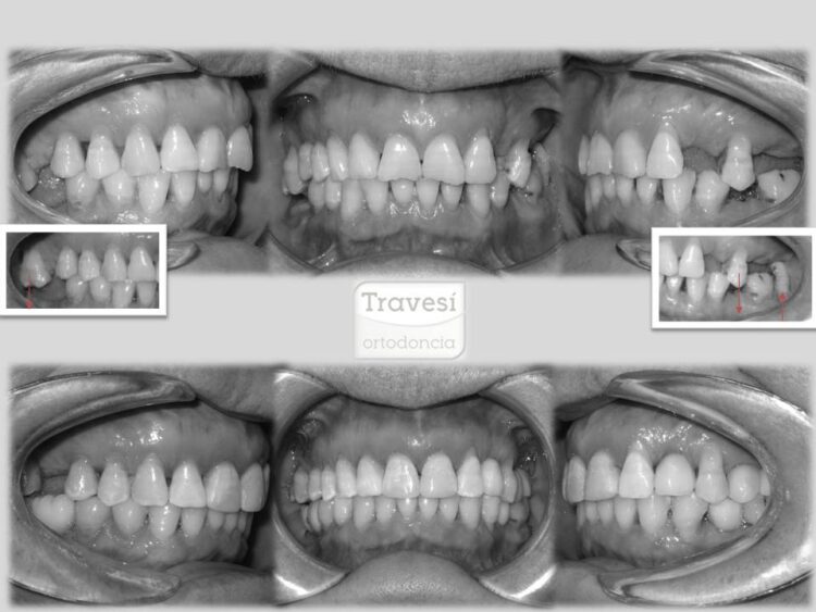 Intrusión de molares para colocación de implantes con invisalign