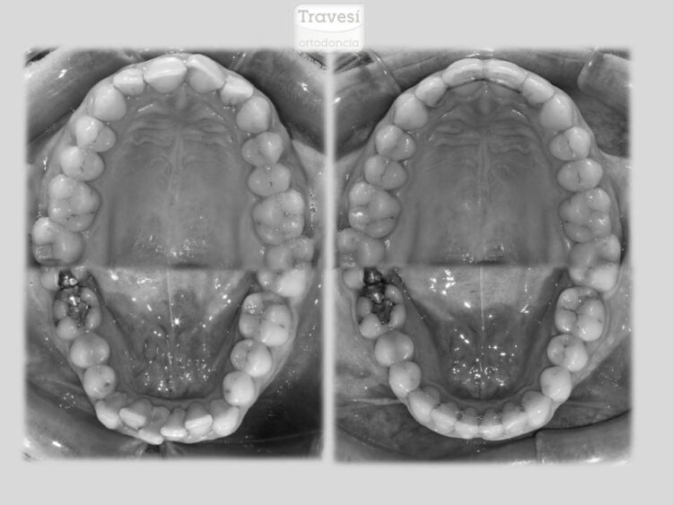 Lite Apiñamiento Oclusal