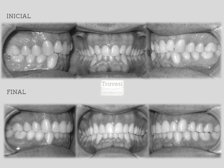 Lite compresion arcadas