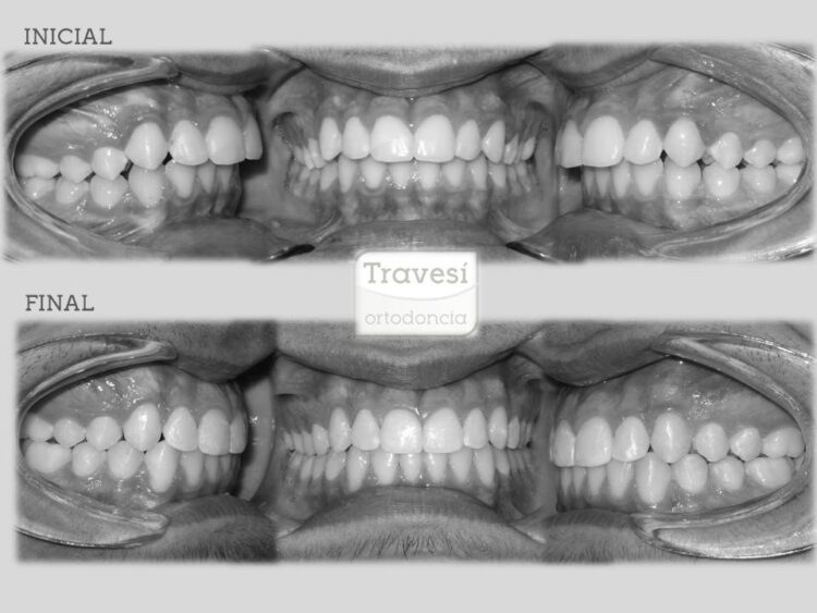 Ortopedia de avance Mandibular con Invisalign