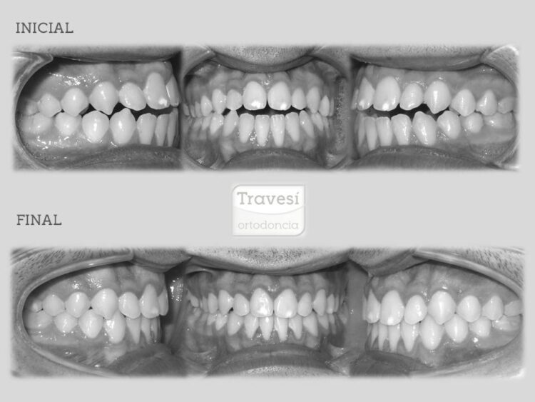 Retratamiento Mordida Abierta