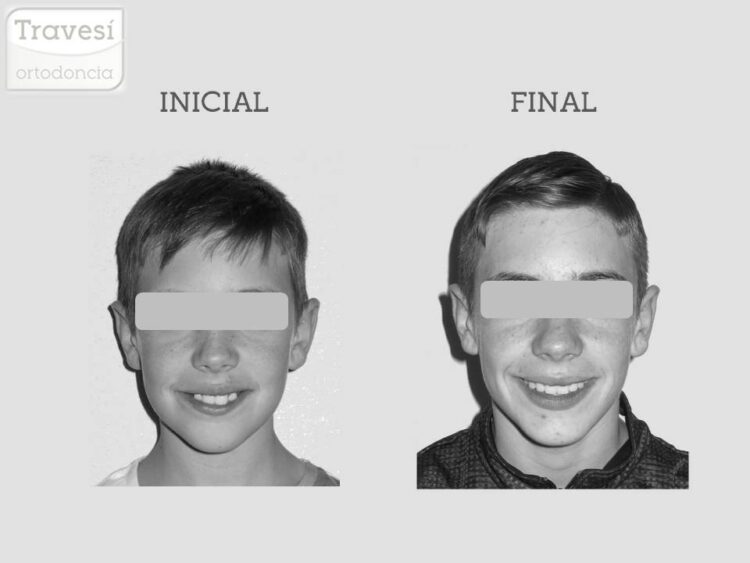 Sonrisa Clase II sobremordida