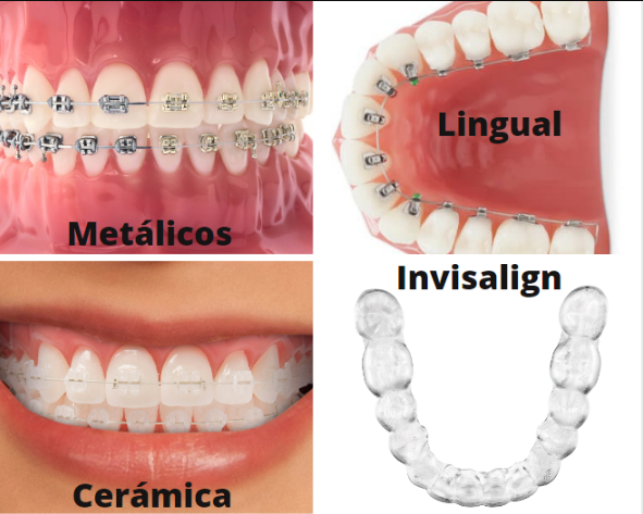 Ortodoncia Tipos