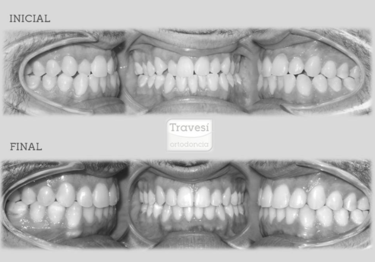 Invisalign: ¿Cúando se empieza a notar?