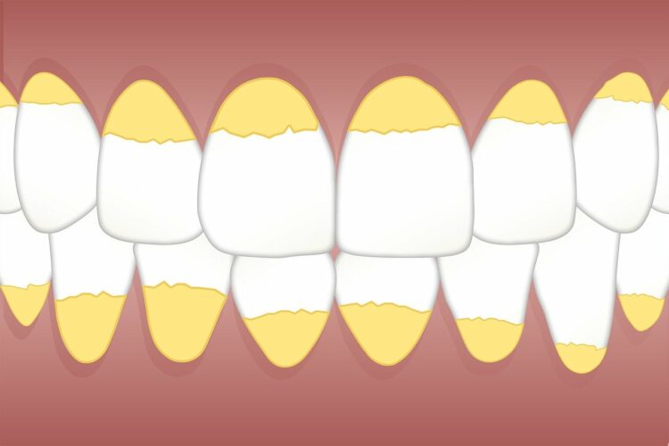 ¿Qué es el sarro y por qué sale en los dientes?